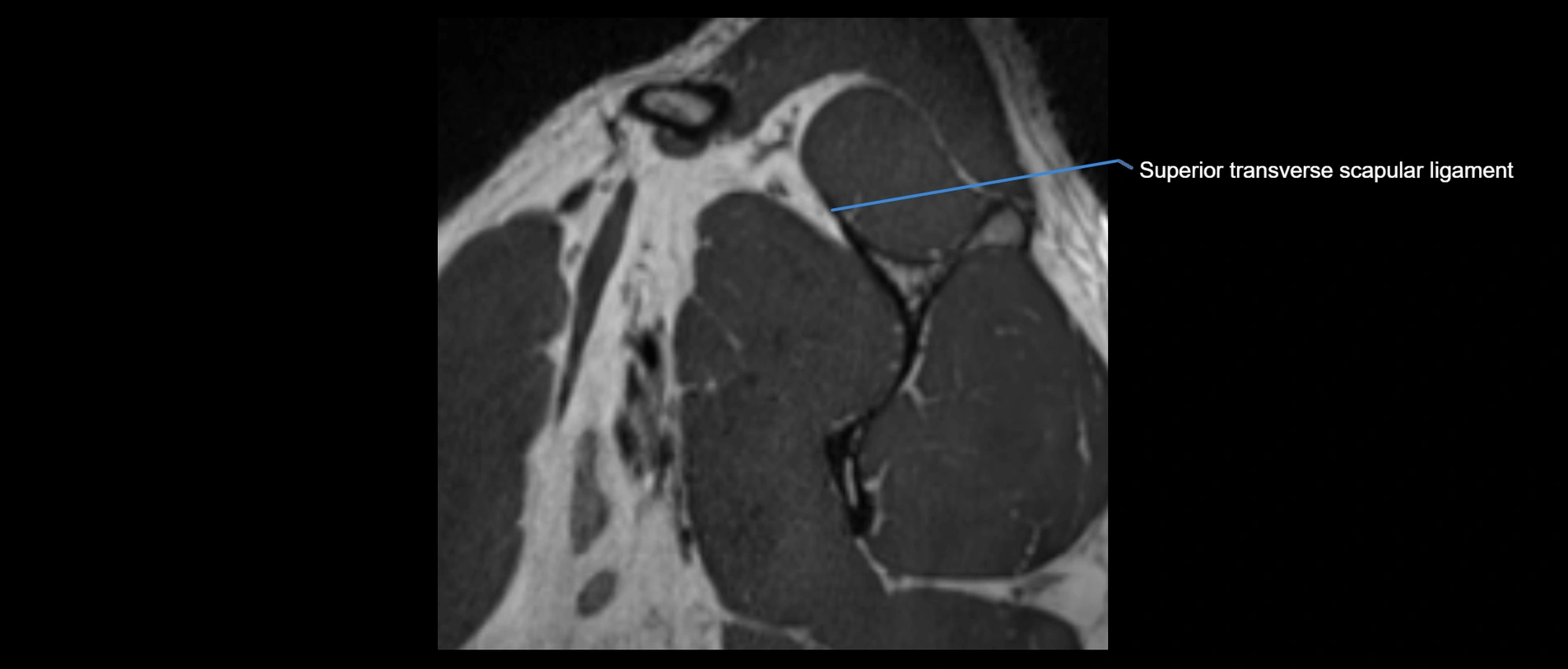 shoulder ligaments sagittal  cross sectional anatomy 3T MRI AI enhanced radiology image -img-00001-00007.webp